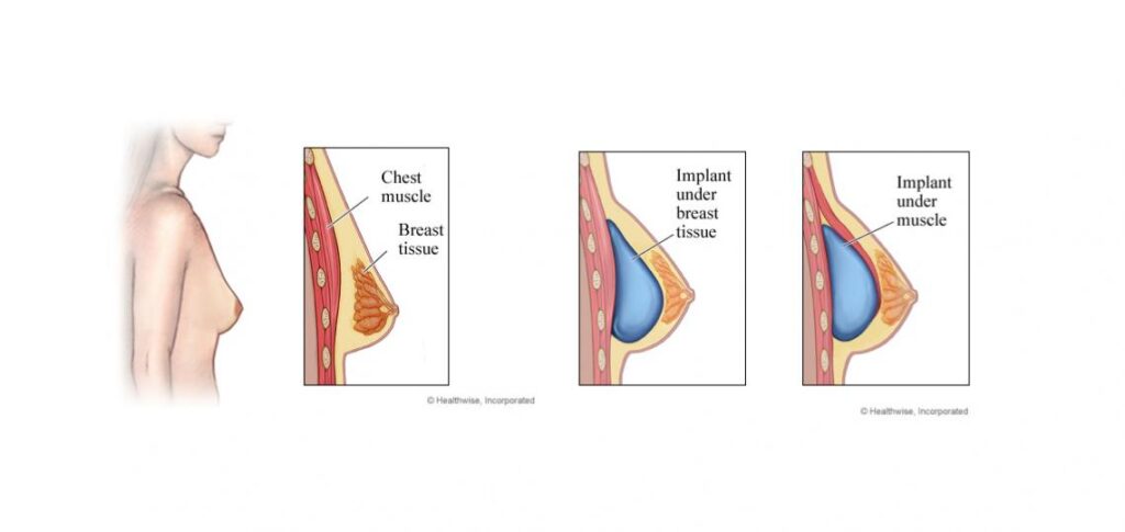 Breast Augmentation