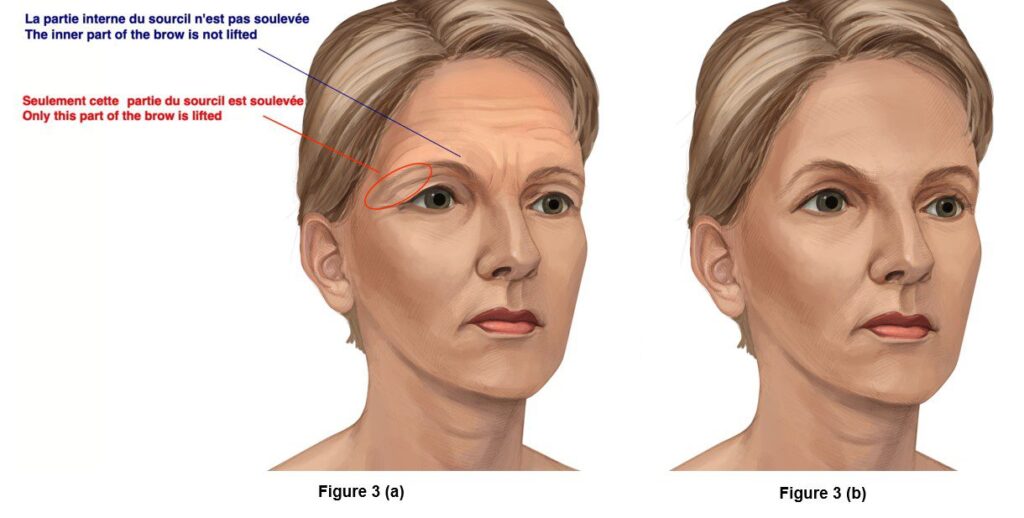 Brow Lift
